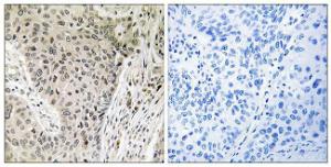 Immunohistochemical analysis of paraffin-embedded human lung carcinoma using Anti-ARHGEF19 Antibody. The right hand panel represents a negative control, where the antibody was pre-incubated with the immunising peptide