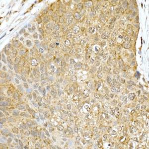 Immunohistochemistry analysis of paraffin-embedded human esophageal cancer using Anti-DDIT3 Antibody (A306791) at a dilution of 1:100 (40x lens)