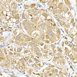 Immunohistochemistry analysis of paraffin-embedded human liver cancer using Anti-DDIT3 Antibody (A306791) at a dilution of 1:100 (40x lens). Perform high pressure antigen retrieval with 10 mM citrate buffer pH 6.0 before commencing with IHC staining protocol