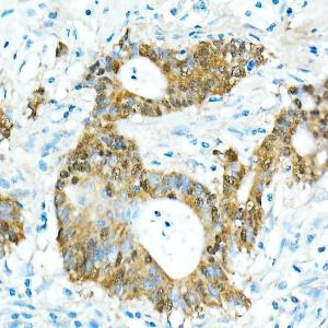 Immunohistochemistry analysis of paraffin-embedded human colon carcinoma tissue using Anti-CDX2 Antibody [ARC0450] (A308015) at a dilution of 1:300 (40X lens). Perform microwave antigen retrieval with 10 mM PBS buffer pH 7.2 before commencing with IHC staining protocol