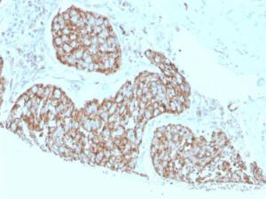 Immunohistochemical analysis of formalin-fixed, paraffin-embedded human breast carcinoma using Anti-Calprotectin Antibody [S100A9/1075]