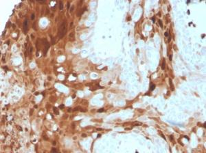 Immunohistochemical analysis of formalin-fixed, paraffin-embedded human skin carcinoma using Anti-Calprotectin Antibody [S100A9/1075]