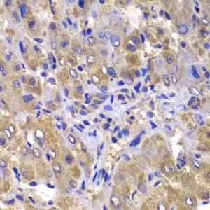 Immunohistochemistry analysis of paraffin-embedded human liver damage using Anti-Carma 3 Antibody (A12107) at a dilution of 1:100 (40x lens). Perform microwave antigen retrieval with 10 mM PBS buffer pH 7.2 before commencing with IHC staining protocol.