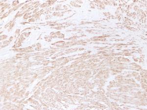 Immunohistochemical analysis of paraffin-embedded human Leiomyoma using Anti-Desmin Antibody