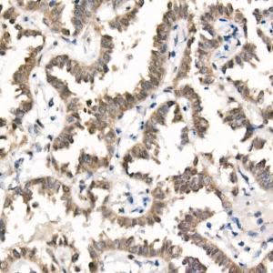 Immunohistochemistry analysis of paraffin-embedded human lung cancer using Anti-TAZ Antibody [ARC57803] (A309490) at a dilution of 1:100 (40X lens). Perform high pressure antigen retrieval with 10 mM citrate buffer pH 6.0 before commencing with IHC staining protocol