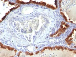 Immunohistochemical analysis of formalin-fixed, paraffin-embedded human lung carcinoma using Anti-Cytokeratin 7 Antibody [KRT7/760]