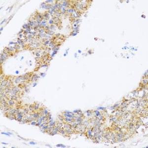 Immunohistochemistry analysis of paraffin-embedded human colon carcinoma tissue using Anti-ZAK Antibody (A12109) at a dilution of 1:100 (40x lens). Perform microwave antigen retrieval with 10 mM PBS buffer pH 7.2 before commencing with IHC staining protocol.