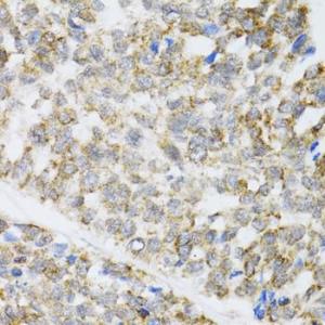 Immunohistochemistry analysis of paraffin-embedded human esophageal cancer using Anti-ZAK Antibody (A12109) at a dilution of 1:100 (40x lens). Perform microwave antigen retrieval with 10 mM PBS buffer pH 7.2 before commencing with IHC staining protocol.