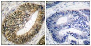 Immunohistochemical analysis of paraffin-embedded human colon carcinoma using Anti-SEPARASE (phospho Ser801) Antibody. The right hand panel represents a negative control, where the antibody was pre-incubated with the immunising peptide.