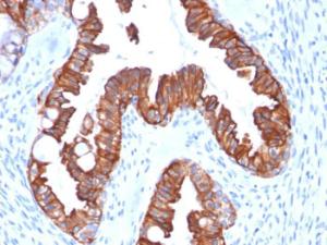 Immunohistochemical analysis of formalin-fixed, paraffin-embedded human endometrial carcinoma using Anti-Cytokeratin 7 Antibody [rOV-TL12/30]