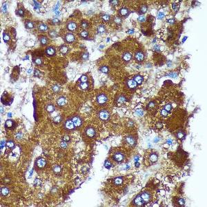 Immunohistochemistry analysis of paraffin-embedded human liver cancer using Anti-Pigu Antibody (A306810) at a dilution of 1:100 (40x lens). Perform microwave antigen retrieval with 10 mM PBS buffer pH 7.2 before commencing with IHC staining protocol.