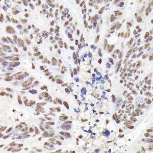 Immunohistochemistry analysis of paraffin-embedded human colon carcinoma tissue using Anti-Rad21 Antibody (A305614) at a dilution of 1:200 (40x lens)