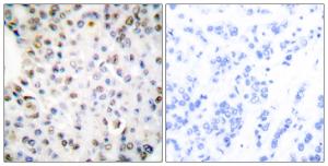 Immunohistochemical analysis of paraffin-embedded human breast carcinoma tissue using Anti-Retinoid X Receptor gamma Antibody. The right hand panel represents a negative control, where the Antibody was pre-incubated with the immunising peptide