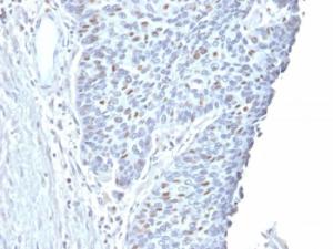 Immunohistochemical analysis of formalin-fixed, paraffin-embedded human endometrial carcinoma using Anti-Cyclin A2 Antibody [CCNA2/2333]