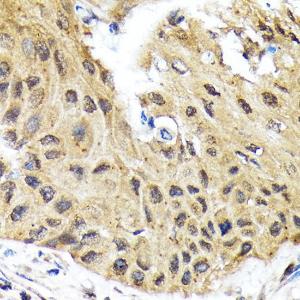 Immunohistochemistry analysis of paraffin-embedded human lung cancer using Anti-EIF2B5 Antibody [ARC1774] (A306812) at a dilution of 1:100 (40X lens). Perform microwave antigen retrieval with 10 mM Tris/EDTA buffer pH 9.0 before commencing with IHC staining protocol