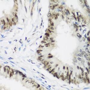 Immunohistochemistry analysis of paraffin-embedded human colon carcinoma tissue using Anti-AEBP2 Antibody (A12114) at a dilution of 1:200 (40X lens). Perform microwave antigen retrieval with 10 mM PBS buffer pH 7.2 before commencing with IHC staining protocol