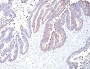 Immunohistochemical analysis of formalin-fixed, paraffin-embedded human colon carcinoma tissue using Anti-COX2 Antibody [COX2/2377]