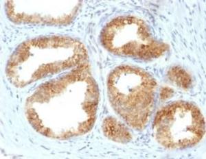 Immunohistochemical analysis of formalin-fixed, paraffin-embedded human prostate cancer tissue using Anti-COX2 Antibody [COX2/2377]