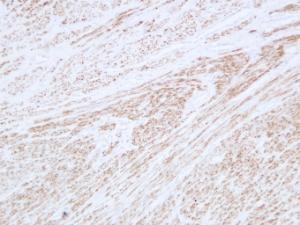 Immunohistochemical analysis of paraffin-embedded human Leiomyoma using Anti-Desmin Antibody