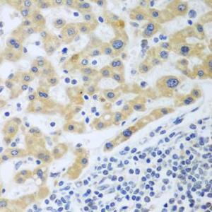 Immunohistochemistry analysis of paraffin-embedded human liver cancer using Anti-SHBG Antibody (A12120) at a dilution of 1:100 (40X lens)