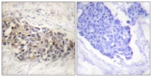 Immunohistochemical analysis of paraffin-embedded human breast carcinoma tissue using Anti-USF2 Antibody The right hand panel represents a negative control, where the antibody was pre-incubated with the immunising peptide