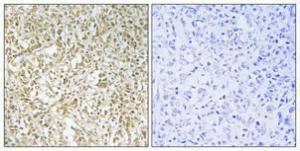 Immunohistochemical analysis of paraffin-embedded human breast cancer using Anti-BARD1 Antibody 1:100 (4 °C overnight). The right hand panel represents a negative control, where the Antibody was pre-incubated with the immunising peptide