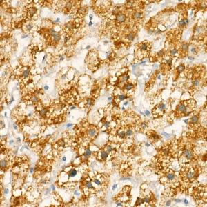 Immunohistochemistry analysis of paraffin-embedded human liver using Anti-MTCO1 Antibody (A12131) at a dilution of 1:20 (40x lens). Perform high pressure antigen retrieval with 10 mM citrate buffer pH 6.0 before commencing with IHC staining protocol.