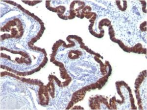 Immunohistochemical analysis of formalin-fixed, paraffin-embedded human ovarian carcinoma using Anti-Cytokeratin 7 Antibody [OV-TL12/30]