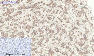 Immunohistochemical analysis of paraffin-embedded human liver cancer tissue using Anti-TR11B Antibody at 1:200 (4 °C overnight). Negative control was secondary Antibody only