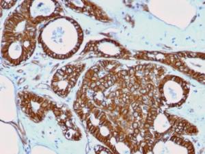 Immunohistochemical analysis of formalin-fixed, paraffin-embedded human breast cancer using Anti-beta Catenin Antibody [rCTNNB1/2173]