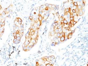 Immunohistochemical analysis of formalin-fixed, paraffin-embedded human lung squamous cell carcinoma using Anti-Cytokeratin 7 Antibody [OV-TL12/30]