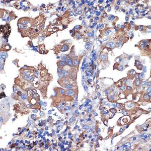 Immunohistochemistry analysis of paraffin-embedded human lung cancer using Anti-VPS11 Antibody [ARC2325] (A306832) at a dilution of 1:100 (40X lens). Perform microwave antigen retrieval with 10 mM Tris/EDTA buffer pH 9.0 before commencing with IHC staining protocol