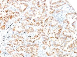 Immunohistochemical analysis of formalin-fixed, paraffin-embedded human lung squamous cell carcinoma using Anti-Cytokeratin 7 Antibody [SPM270]