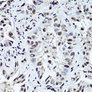 Immunohistochemistry analysis of paraffin-embedded human lung cancer using Anti-ATR (phospho Thr1989) Antibody (A308032) at a dilution of 1:200 (40X lens). Perform high pressure antigen retrieval with 10 mM citrate buffer pH 6.0 before commencing with IHC staining protocol