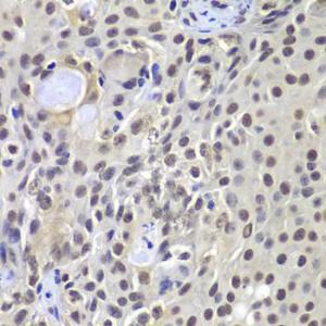 Immunohistochemistry analysis of paraffin-embedded human well-differentiated squamous skin carcinoma using Anti-DNA PKcs Antibody (A12159) at a dilution of 1:100 (40x lens) Perform microwave antigen retrieval with 10 mM PBS buffer pH 72 before commencing with IHC staining protocol