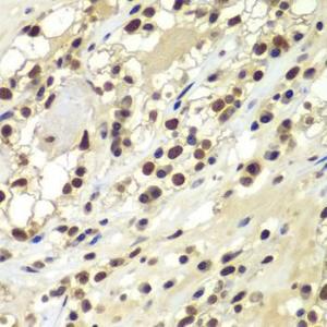 Immunohistochemistry analysis of paraffin-embedded human kidney cancer using Anti-DNA PKcs Antibody (A12159) at a dilution of 1:100 (40x lens) Perform microwave antigen retrieval with 10 mM PBS buffer pH 72 before commencing with IHC staining protocol