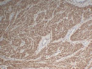 Immunohistochemical analysis of paraffin-embedded human Fibroid using Anti-Desmin Antibody