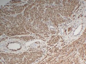 Immunohistochemical analysis of paraffin-embedded human Fibroid using Anti-Desmin Antibody