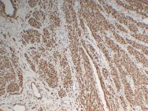 Immunohistochemical analysis of paraffin-embedded human Fibroid using Anti-Desmin Antibody