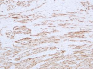 Immunohistochemical analysis of paraffin-embedded human Leiomyoma using Anti-Desmin Antibody