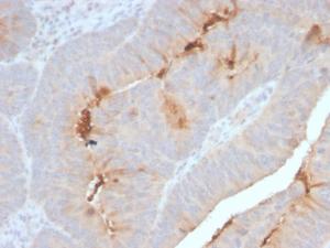 Immunohistochemical analysis of formalin-fixed, paraffin-embedded human colon carcinoma using Anti-Serum Amyloid A Antibody [SAA/2868R]