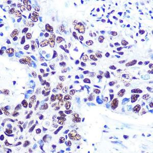 Immunohistochemistry analysis of paraffin-embedded human lung cancer using Anti-RBBP4 Antibody [ARC0813] (A306852) at a dilution of 1:100 (40x lens). Perform microwave antigen retrieval with 10 mM PBS buffer pH 7.2 before commencing with IHC staining protocol