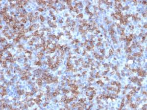 Immunohistochemical analysis of formalin-fixed, paraffin-embedded human lymphoma using Anti-CD8A Antibody [C8/1779R]