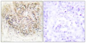 Immunohistochemical analysis of paraffin-embedded human breast carcinoma tissue using Anti-TCTP Antibody. The right hand panel represents a negative control, where the antibody was pre-incubated with the immunising peptide.