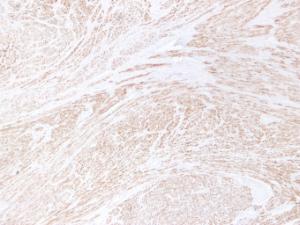 Immunohistochemical analysis of paraffin-embedded human Leiomyoma using Anti-Desmin Antibody