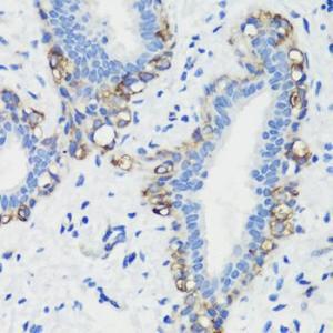 Immunohistochemistry analysis of paraffin-embedded human breast cancer tissue using Anti-Filamin A Antibody (A12186) at a dilution of 1:100 (40X lens). Perform microwave antigen retrieval with 10 mM PBS buffer pH 7.2 before commencing with IHC staining protocol