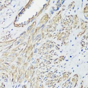 Immunohistochemistry analysis of paraffin-embedded human uterine cancer using Anti-Filamin A Antibody (A12186) at a dilution of 1:100 (40X lens). Perform microwave antigen retrieval with 10 mM PBS buffer pH 7.2 before commencing with IHC staining protocol