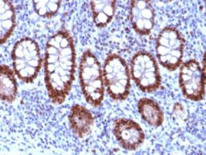 Immunohistochemical analysis of formalin-fixed, paraffin-embedded human colon carcinoma tissue using Anti-PU1 Antibody [PU1/2118]