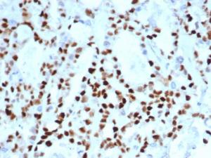 Immunohistochemical analysis of formalin-fixed, paraffin-embedded human ovarian carcinoma using Anti-Cyclin E Antibody [CCNE1/4935R]