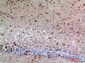 Immunohistochemical analysis of paraffin-embedded human kidney cancer using Anti-SNCA Antibody